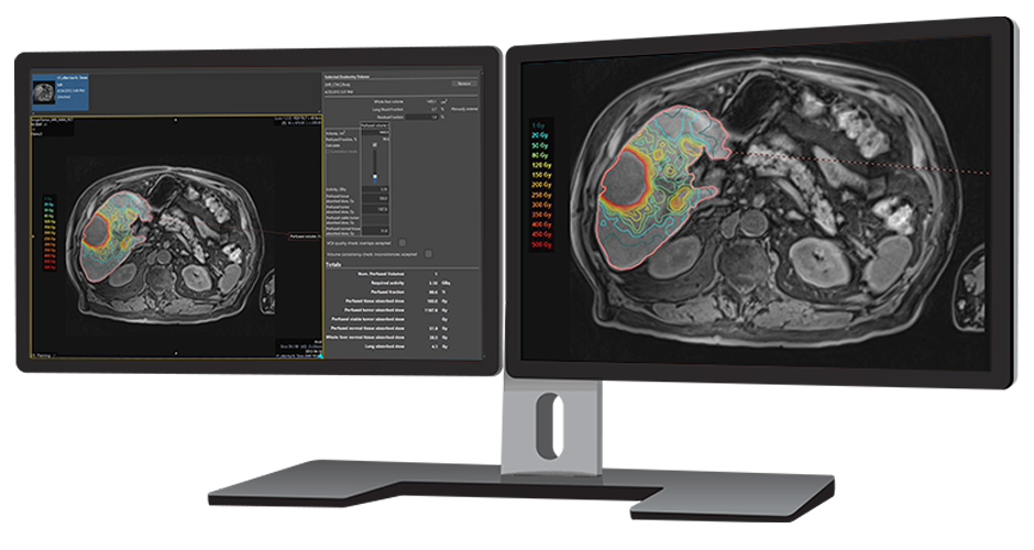 image of monitors displaying Simplicit<sup>90</sup>Y™ software solution for dosimetry planning.