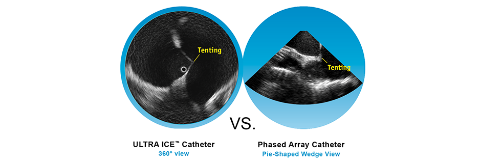 ULTRA ICE catheter vs Phased Array