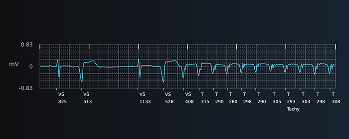 Tachycardia S-ECG report strip from Boston Scientific LUX-Dx II+ Insertable Cardiac Monitor.