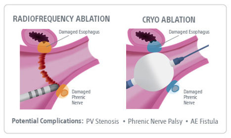 Radiofrequency ablation and cryo ablation, with potential complications of PV stenosis, phrenic nerve palsy, and AE fistula.