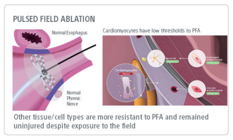 Pulsed field ablation: other tissues/cell types are more resistant to PFA, remained uninjured despite exposure to the field.