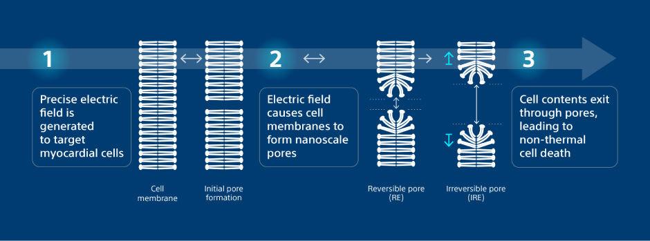 Precise electric field targets myocardial cells; cell membranes form nanoscale pores; cell contents exit through pores.