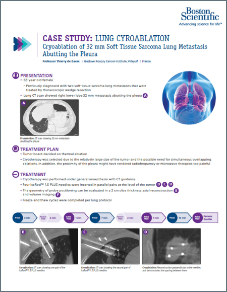 Soft Tissue Met Cryoablation case study 