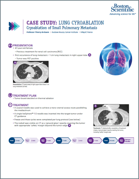 Small Lung Met Cryoablation case study 