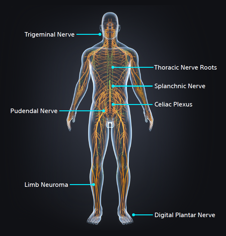 image of skeleton with nerve targets labeled.
