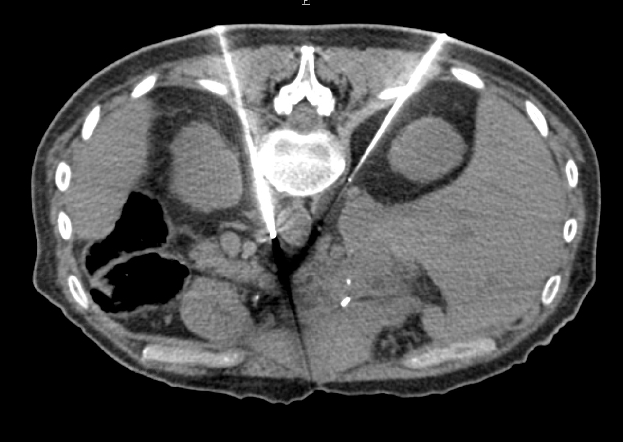 Two IceRod 1.5 CX needles placed within and along the bilateral celiac plexus via CT-guidance.