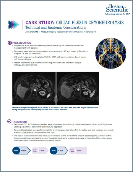 PDF Celiac Plexus Cryoneurolysis case study 