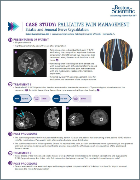 PDF Sciatic and Femoral Nerve Cryoablation case study