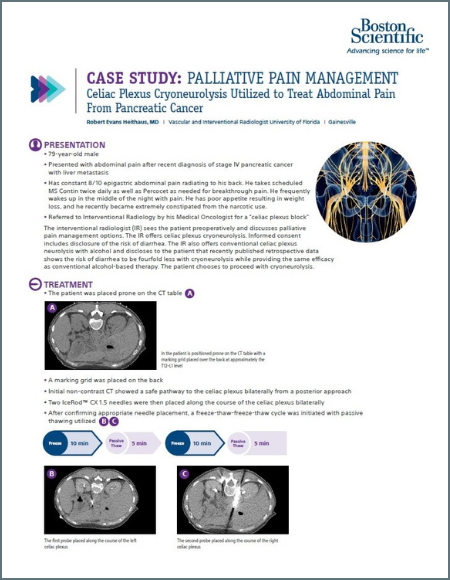 PDF Cryoneurolysis for Pancreatic Cancer Pain case study