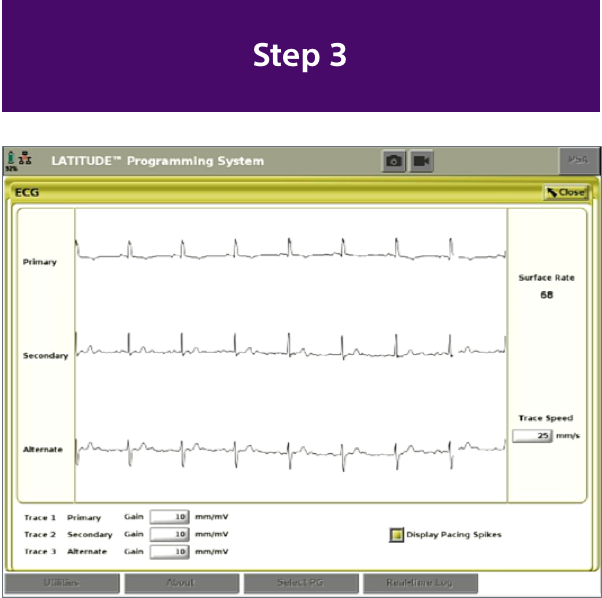 ECG screen of the Automated Screening Tool.
