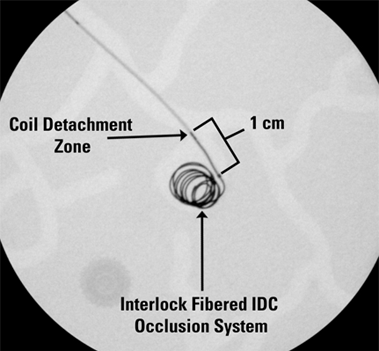 Interlock Fibered IDC Occlusion System Coil Detachment Zone