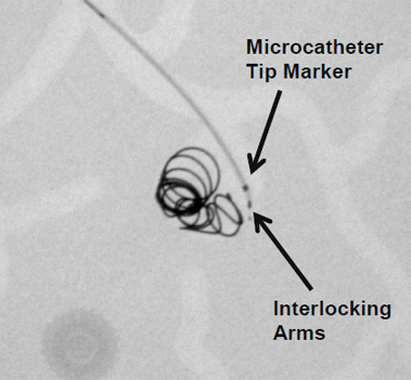 Interlock Fibered IDC Occlusion System Interlocking Arms