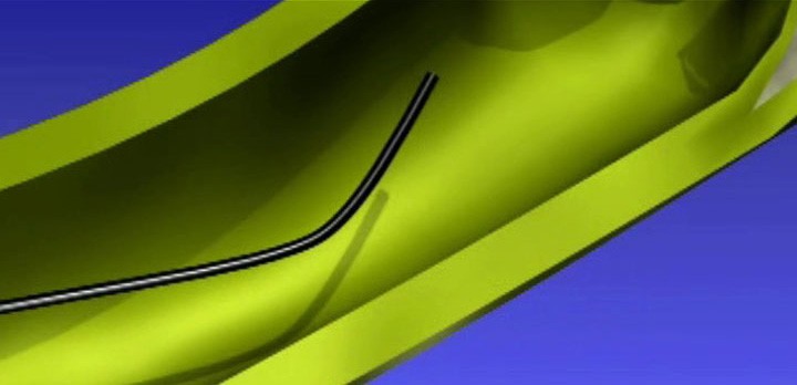 Image of The Dreamwire High Performance Guidewire forming an alpha loop as it passes through a stricture.