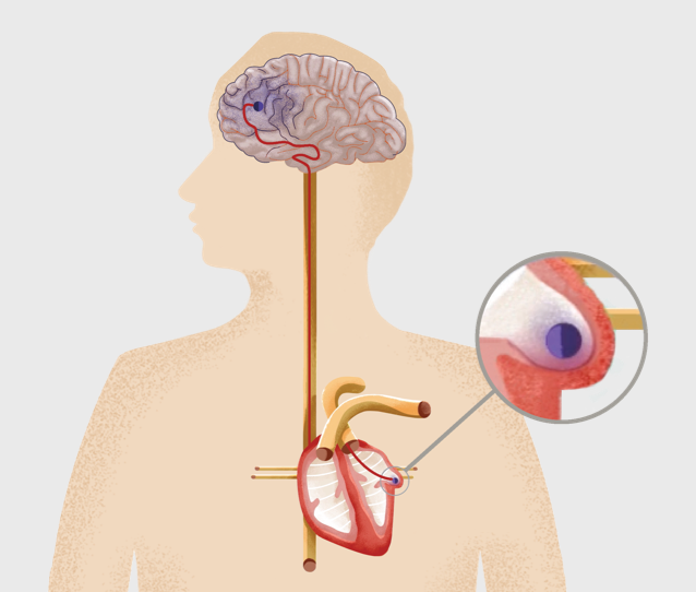 illustration of atrial fibrillation 