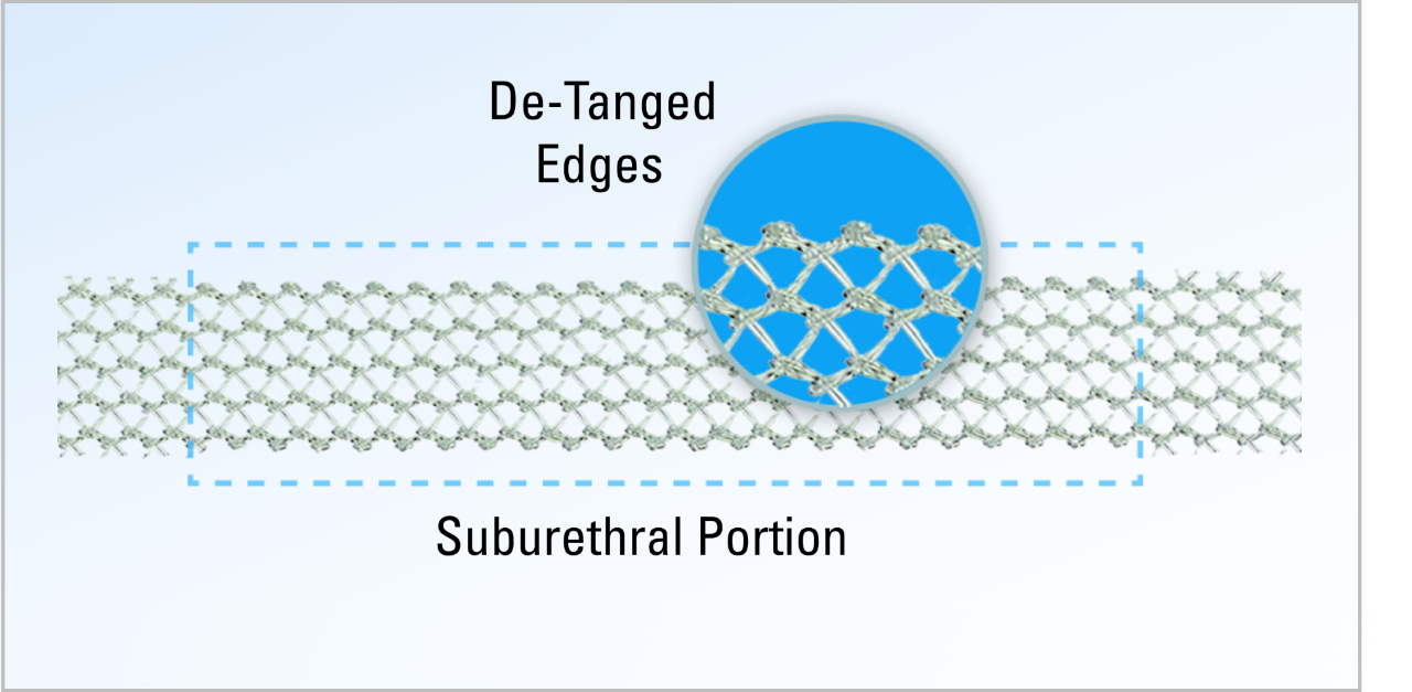 De-tanged edges visual on suburethal portion of mesh.
