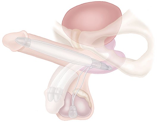 AMS Ambicor Inflatable Penile Prosthesis