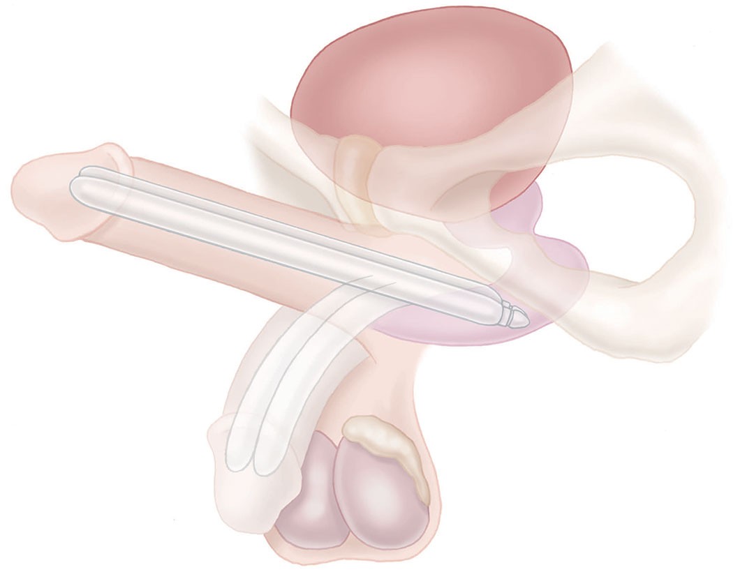 Features & Benefits | Spectra™ Concealable Penile Prosthesis