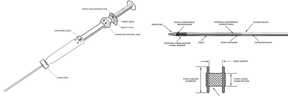 Schematic illustration of AXIOS™ Stent and Electrocautery Enhanced Delivery System