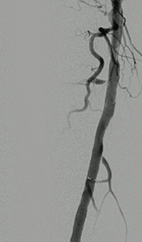 Thrombectomy of Occluded SFA - post-adjunctive treatment