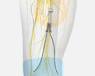 Medical nerve stimulation implant illustration.