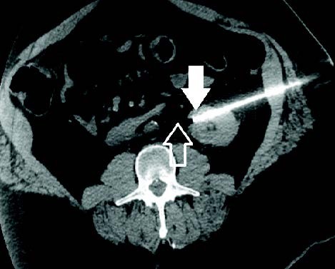 IceForce 2.1 CX Needle successfully used to perform cryoablation on anterior aspect of the lower pole of the left kidney.