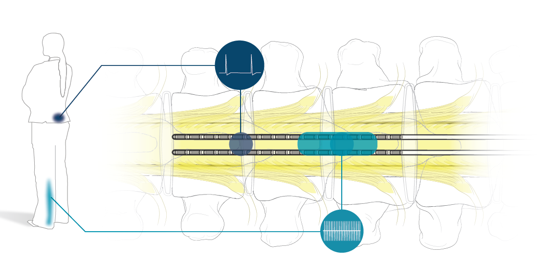 Boston Scientific SCS IPGs and surgical leads