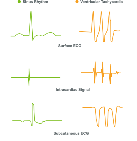 ECG / EKG of subcutaneous signal