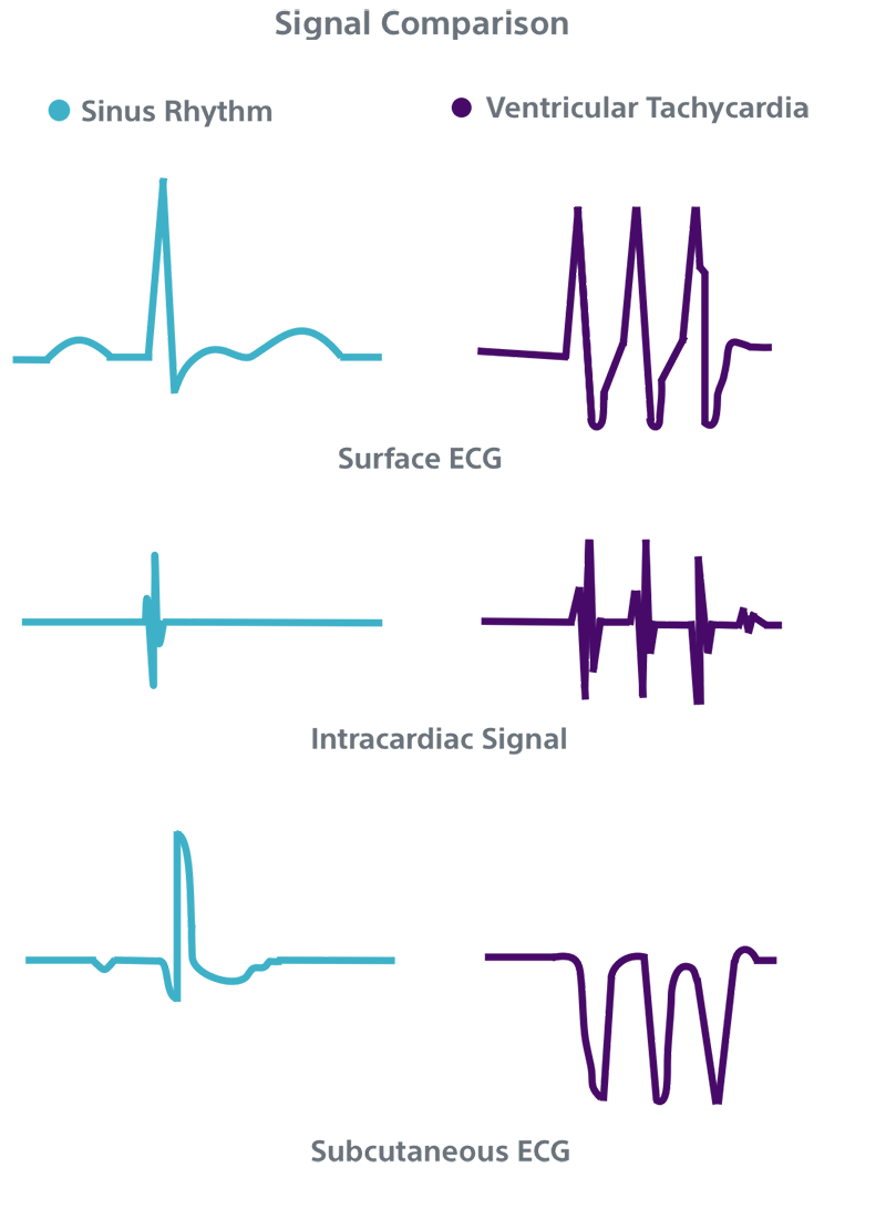 Comparison of sinus rhythm and ventricular tachycardia for surface ECG, intracardiac signal and subcutaneous ECG.