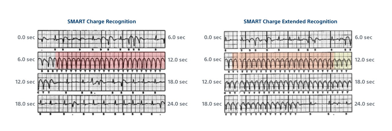 SMART Charge Recognition ECG data for an untreated episode.  