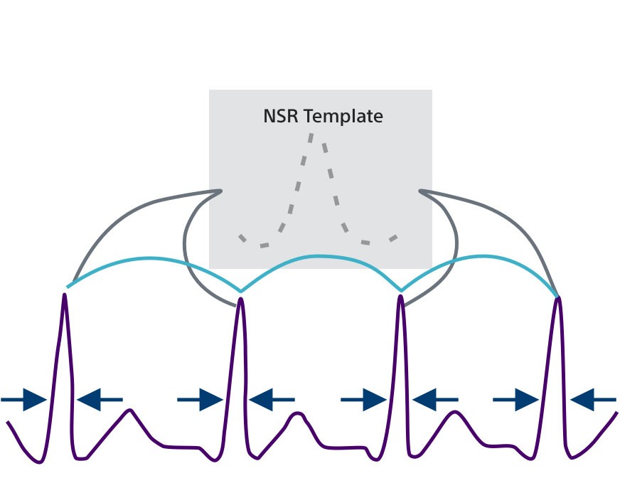 Diagram showing how the Normal Sinus Rhythm (NSR) template identifies non-shockable rhythms in the Conditional Shock Zone.