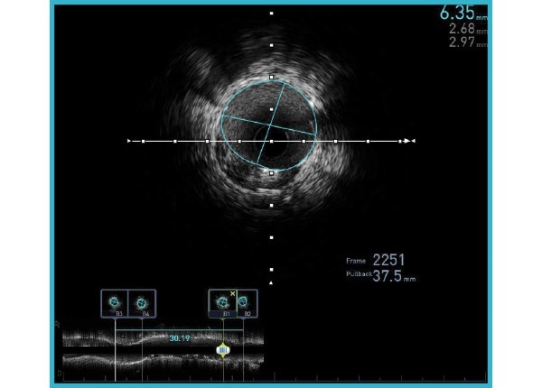 Automated Lesion Assessment (ALA™)