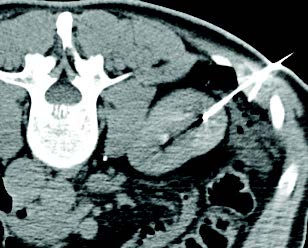 Cryoablation successfully performed with three IceRod 1.5 CX needles for treatment of renal cell carcinoma.