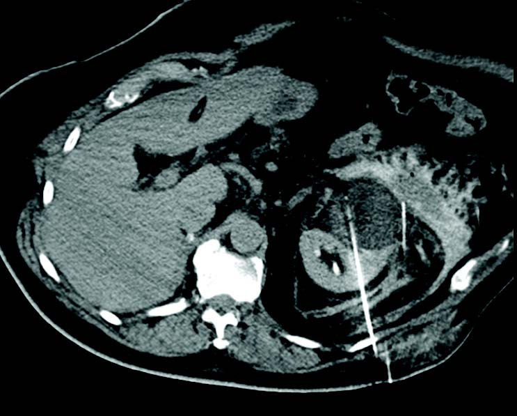Cryoablation performed on 7cm left anterior conventional clear cell RCC using IceRod 1.5 Plus needles..