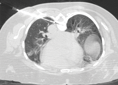 Cryoablation of mCRC in the lung located adjacent to the aorta courtesy of Thierry de Baere, MD, Gustave Roussy Cancer Institute, Villejuif, France.