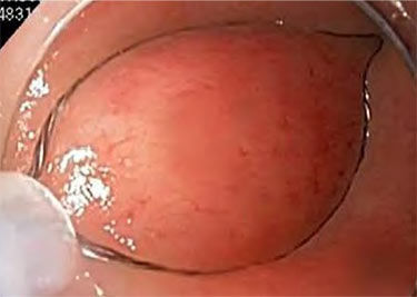 Example of Round Shape Resection
