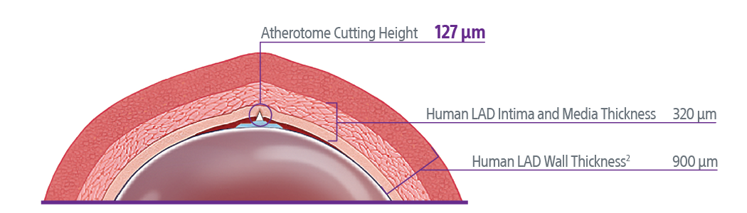 Wolverine Atherotome – Smaller Profile Cutting Balloon
