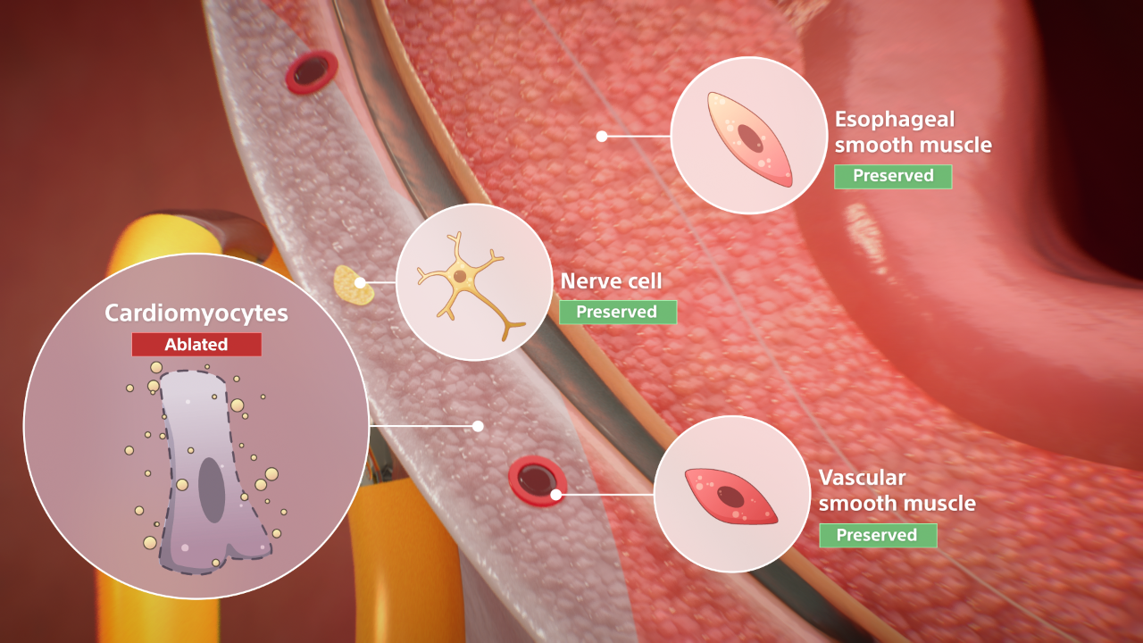 Cardiomyocytes are ablated; nerve cell, esophageal smooth muscle, and vascular smooth muscle are preserved.