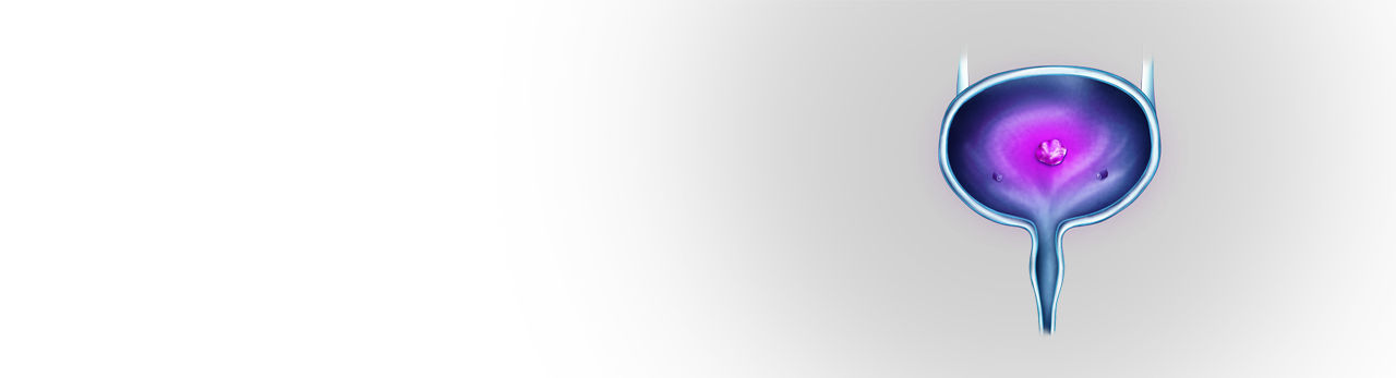 c&aacute;lculo urinario cristalino