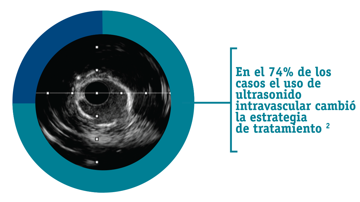 In fact, the use of IVUS has been shown to change treatment decisions 74% of the time. ​