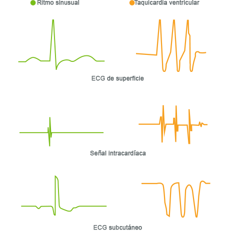 ECG/EKG de la señal subcutánea