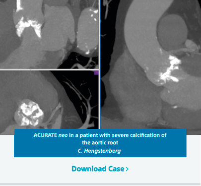 ACURATE neo in a patient with severe calcification of the aortic root