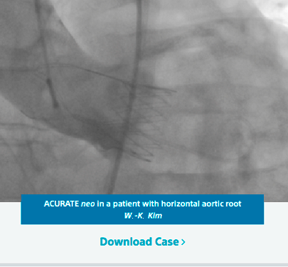 ACURATE Neo is in a patient with horizontal aortic root