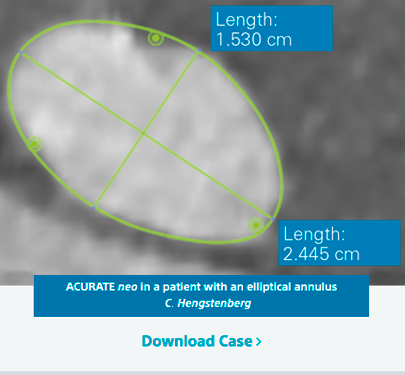 ACURATE neo in a patient with an elliptical annulus