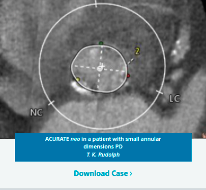 ACURATE neo in a patient with small annular dimensions PD