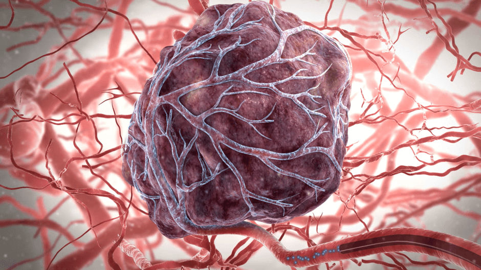 Therasphere™ Y90 Glass Microspheres