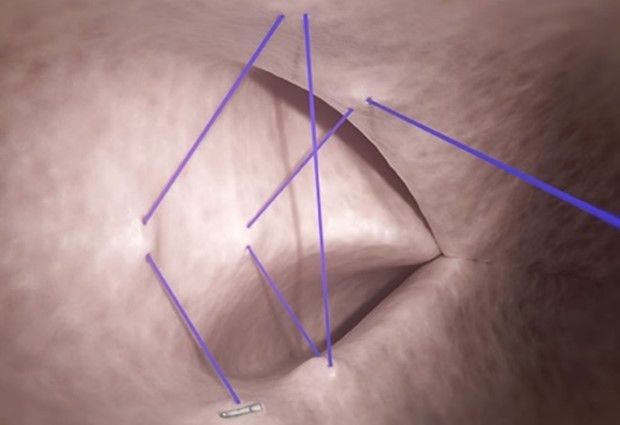 Foto de cierre del defecto