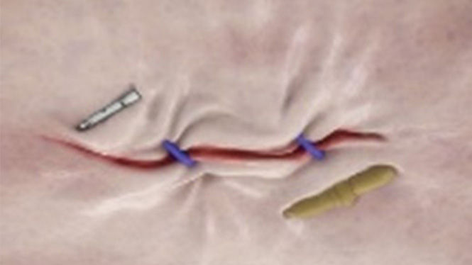 Foto de cierre del defecto