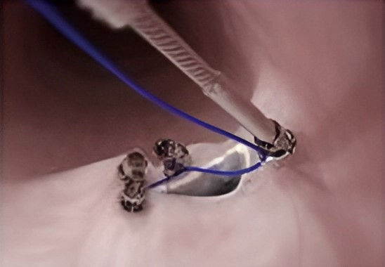 Foto de cierre del defecto