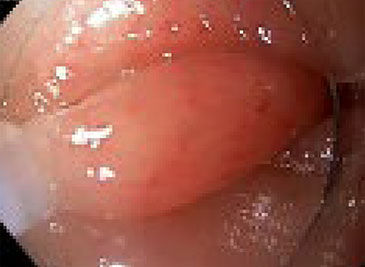 Example of Thin Wire Resection