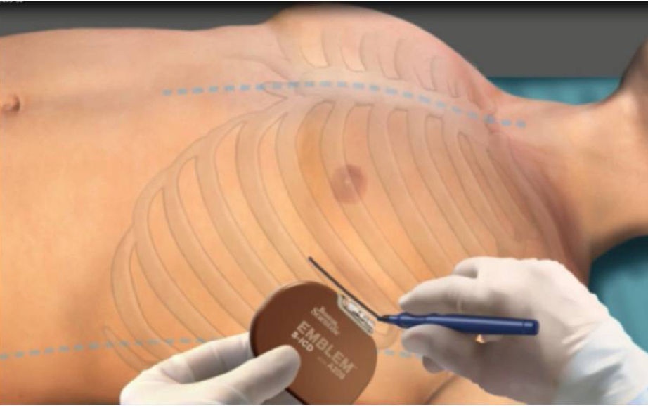 implant procedure